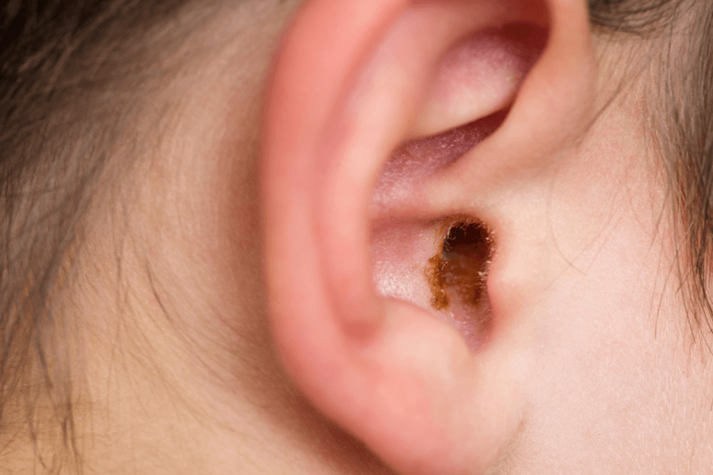 Why One Ear Produces More Earwax Than the Other