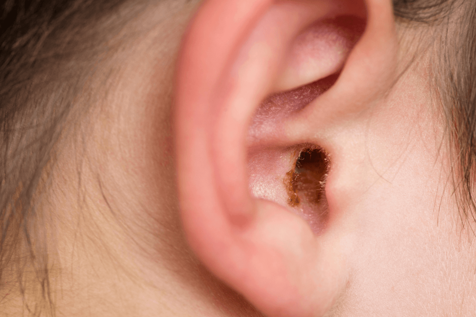 Why One Ear Produces More Earwax Than the Other