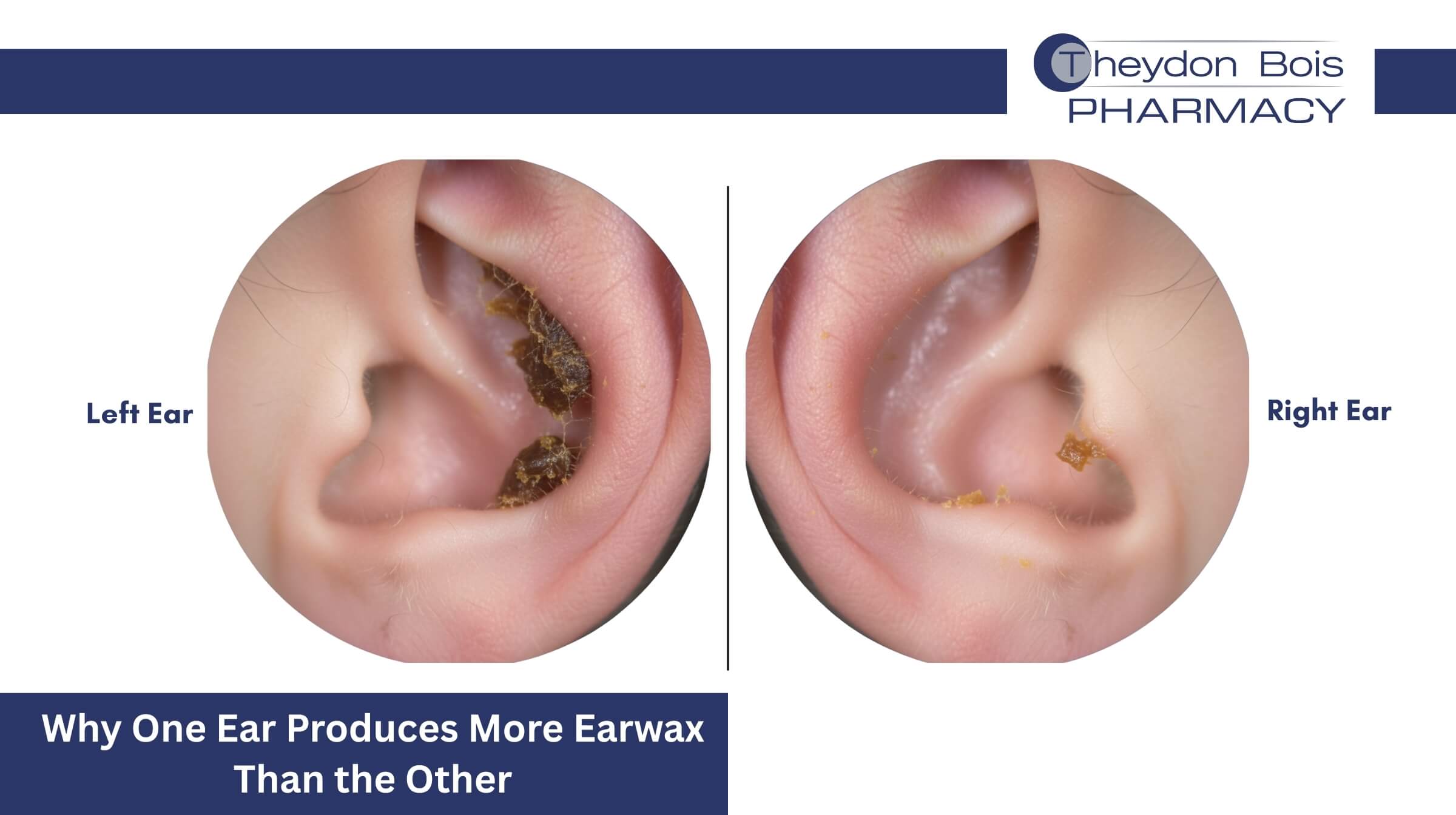 Why One Ear Produces More Earwax Than the Other